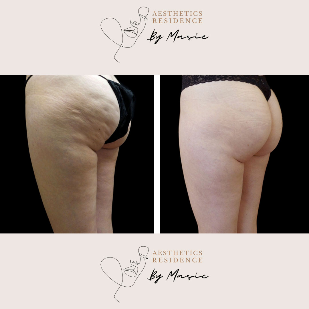 Cellulite-Treatment-–-Injection-Method-before-after