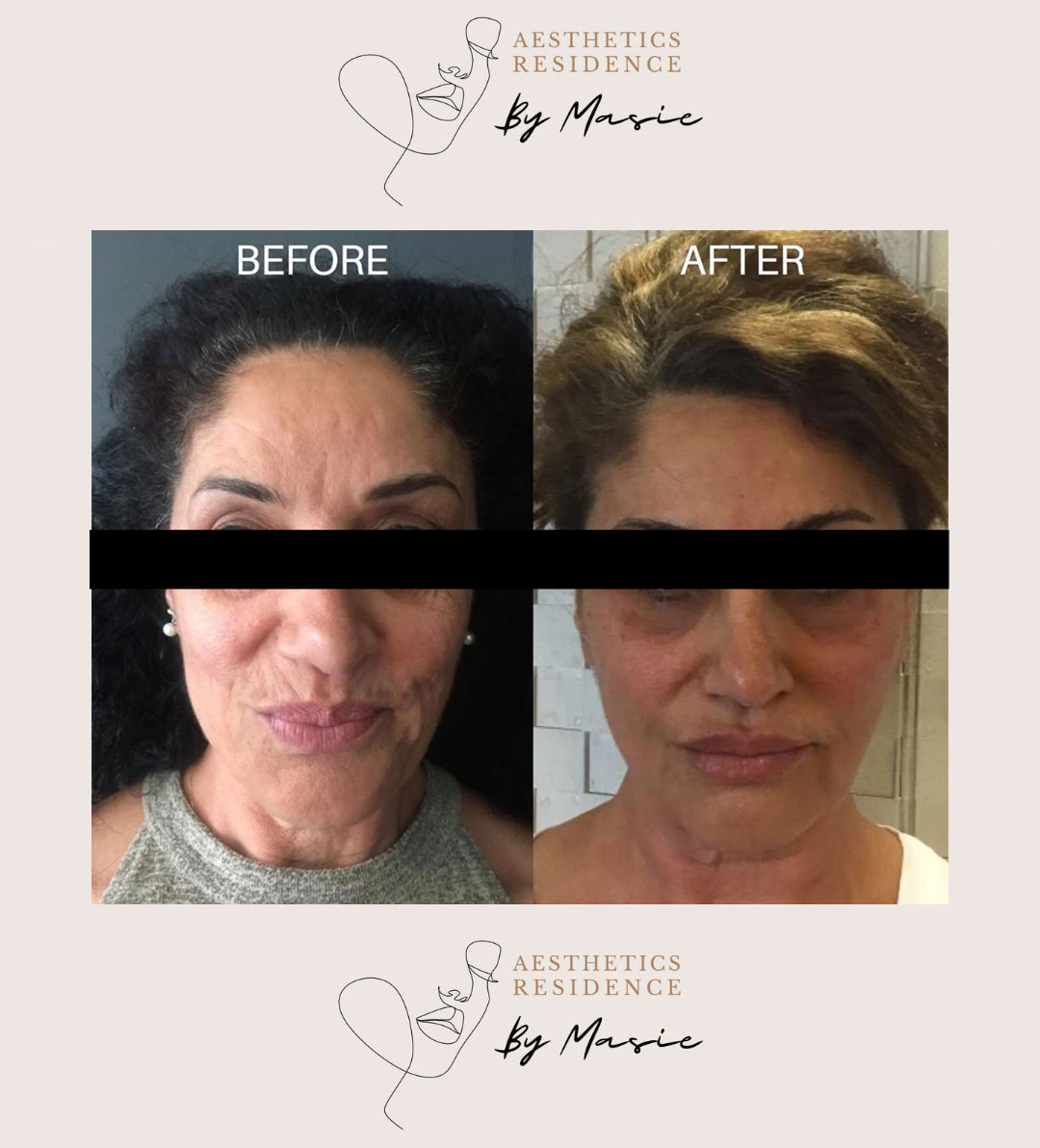 Injectable-Skin-Tightening-before-and-after003