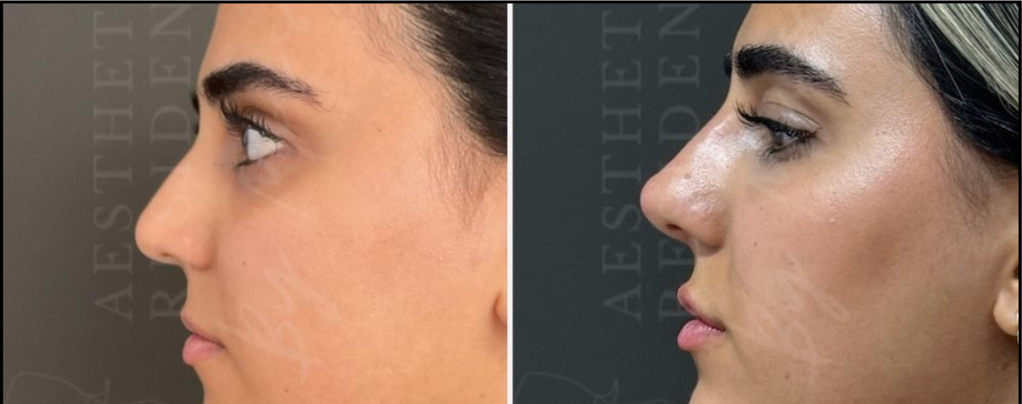 Non-Surgical Rhinoplasty