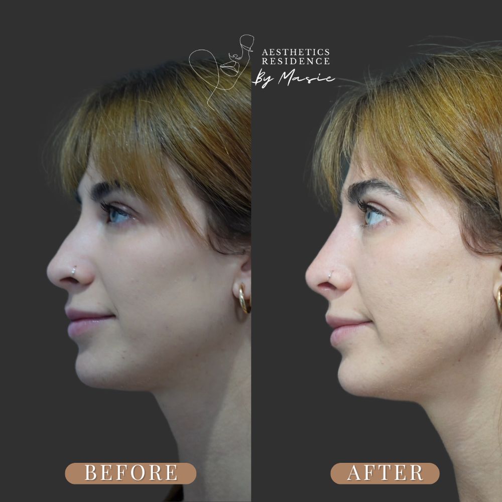 Non-Surgical-Rhinoplasty