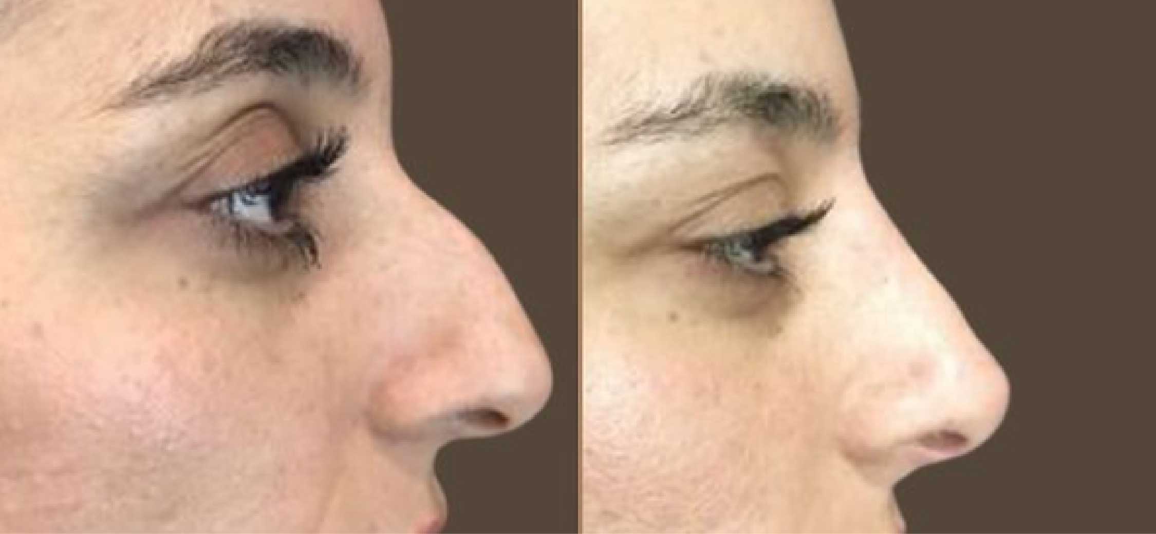 Non-Surgical Rhinoplasty-01